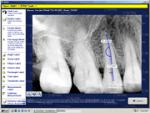 Apteryx XrayVision Full Latest Version